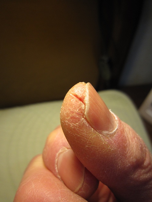 割れる 指先 ぱっくり割れ,指のひび割れの治し方！絆創膏,よく効く薬など